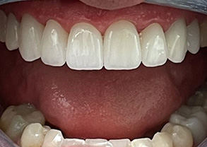 Smile Gallery - After