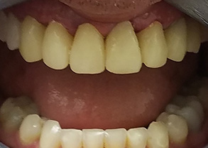 Smile Gallery - Before