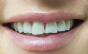 Smile Gallery - Before