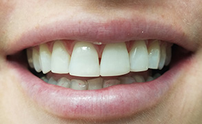 Smile Gallery - After