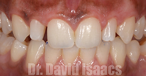 Smile Gallery - Before