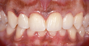 Smile Gallery - After