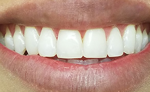 Smile Gallery - After