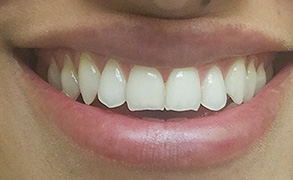 Smile Gallery - Before